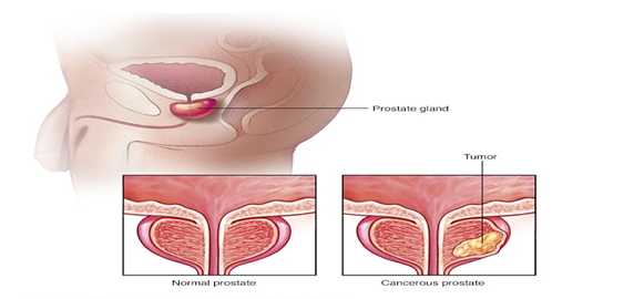 abiraterone acetate tablets, 250 mg film-coated tablets,500 mg film-coated tablets, prostate cancer treatment, Abirataj Taj Pharma